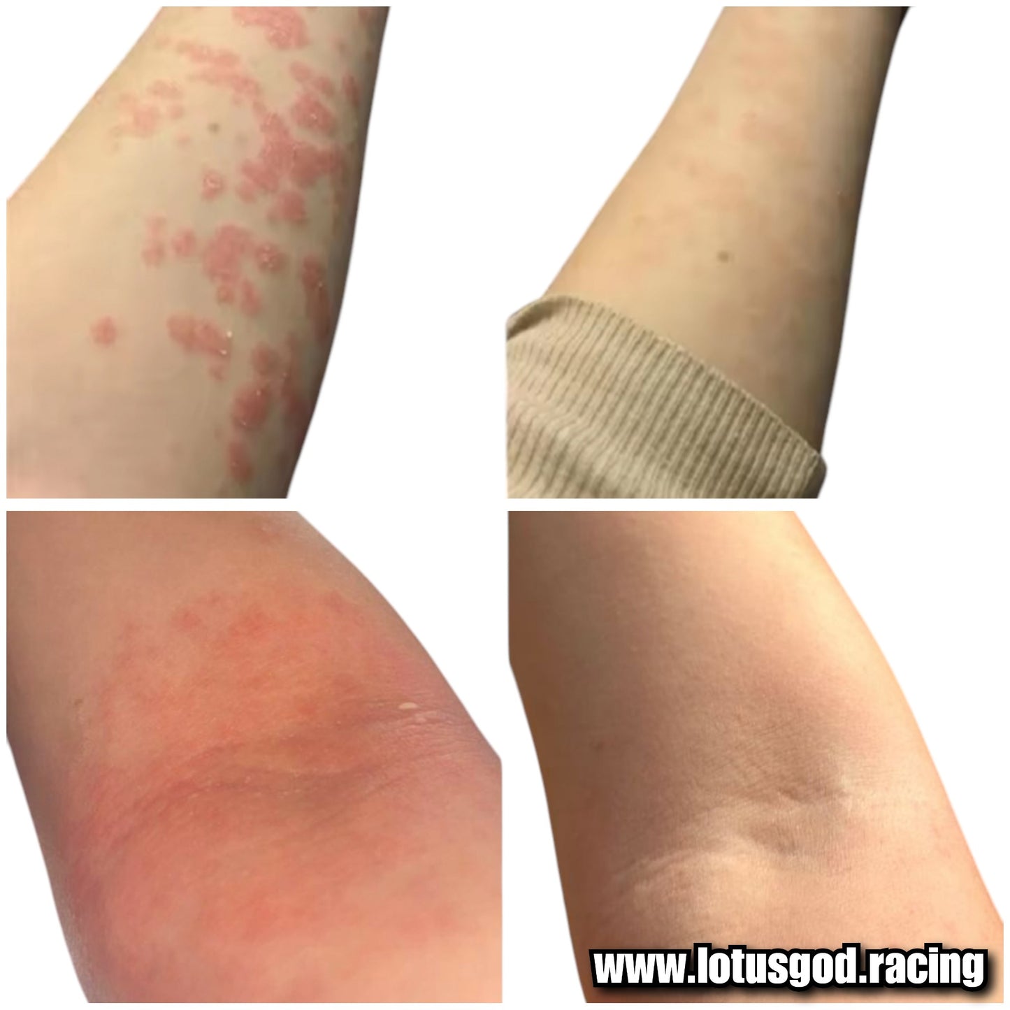 Herbal Miracle Cream Treatment For Eczema Acute Psoriasis Scrotum Itching Rash Dermatitis Antibiosis Ointment Tinea Pedis Inhibit Fungi Skin Care Skin Peeling Redness & Irritation