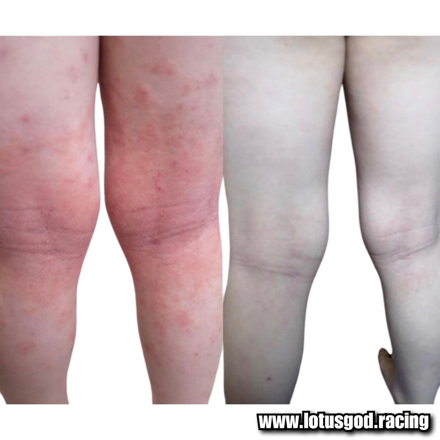 Herbal Miracle Cream Treatment For Eczema Acute Psoriasis Scrotum Itching Rash Dermatitis Antibiosis Ointment Tinea Pedis Inhibit Fungi Skin Care Skin Peeling Redness & Irritation