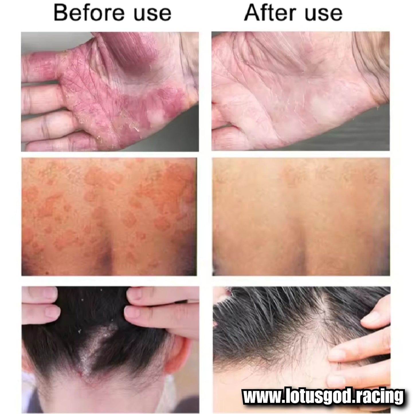 Herbal Miracle Cream Treatment For Eczema Acute Psoriasis Scrotum Itching Rash Dermatitis Antibiosis Ointment Tinea Pedis Inhibit Fungi Skin Care Skin Peeling Redness & Irritation